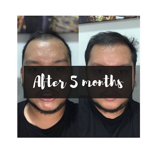 Hair Transplant Solutions